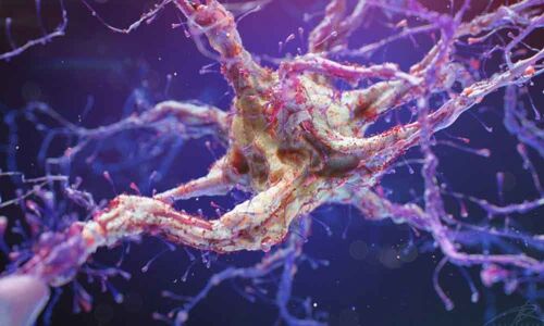 This new drug can prevent Alzheimers