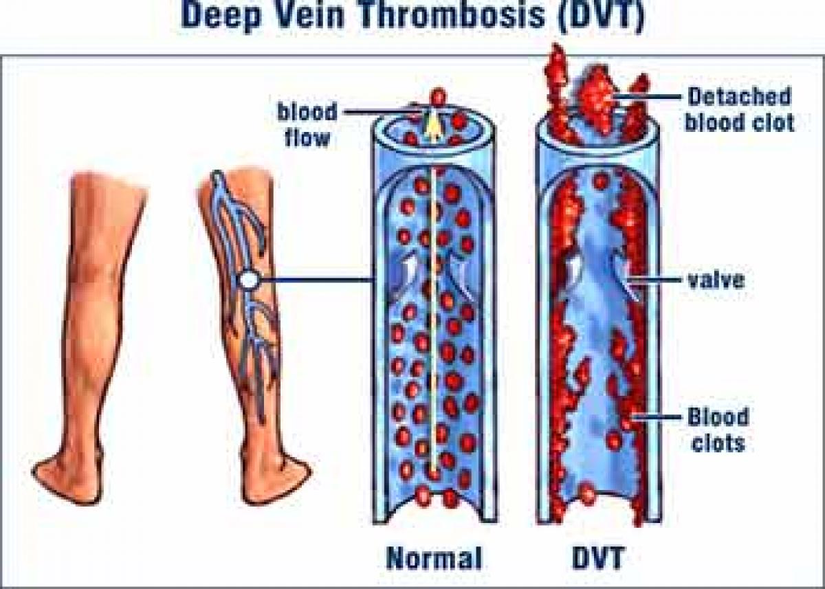 Pollution & obesity can cause blood clots