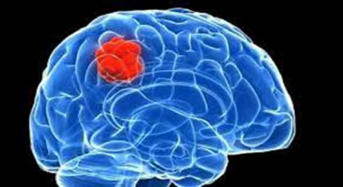 Unraveling The Top 7 Myths About Brain Tumors