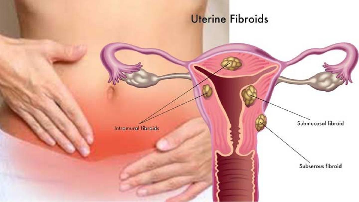 High testosterone levels in women up uterine fibroid risk