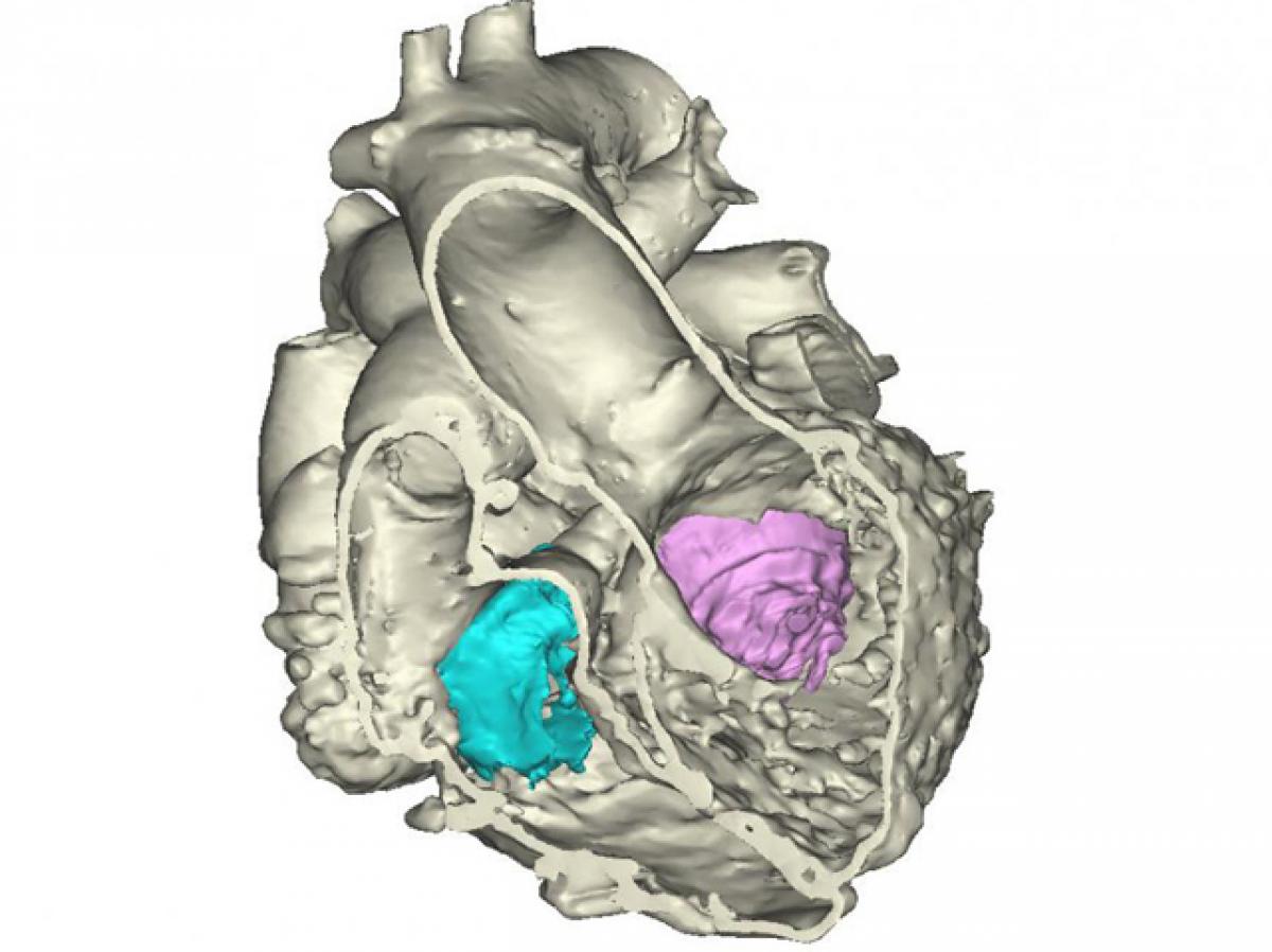 First 3D heart printed using multiple imaging techniques