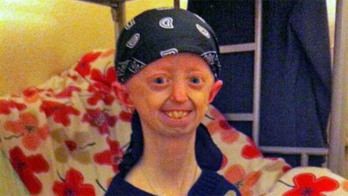 Progeria hit teen girl looks 100 years old