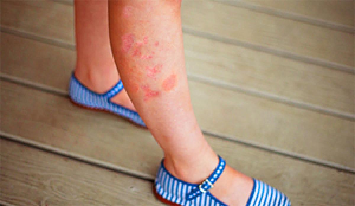 Those with Sensitive skin can fight Psoriasis with this miracle drug