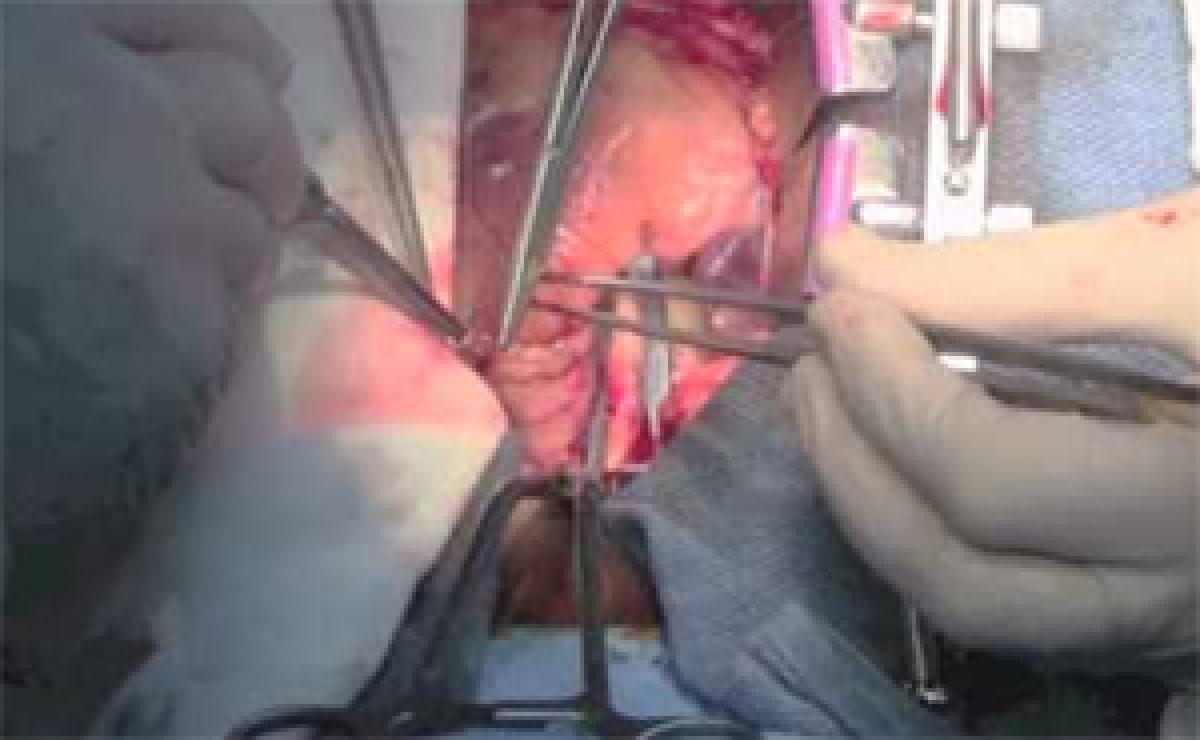 Kerala cardiac surgeon develops reusable stabiliser for beating heart surgery