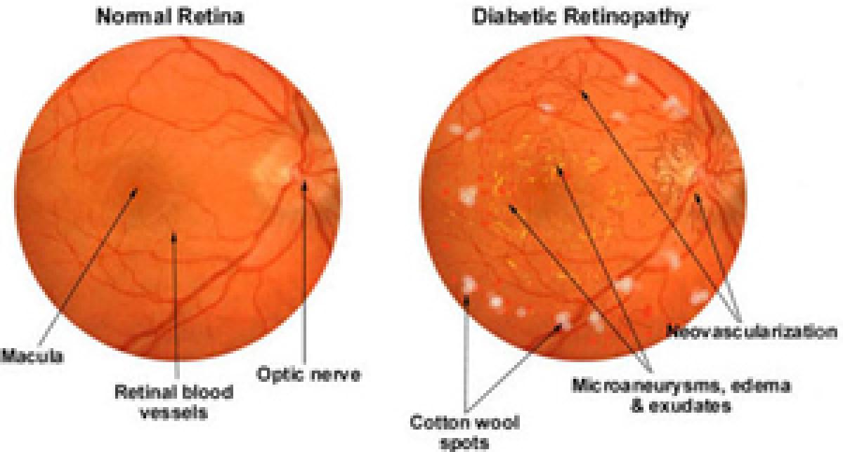 CME on diabetic retinopathy on Sunday