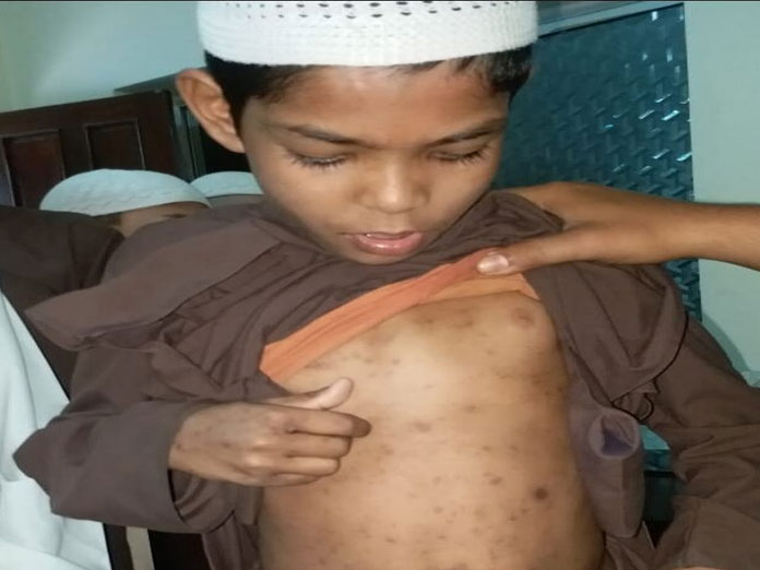 Hyderabad: 104 Madrasa students infected with scabies