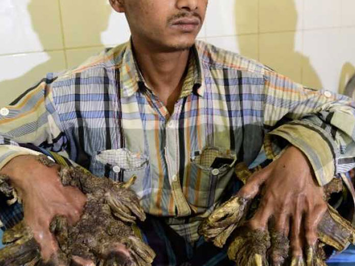 Bangladeshi Tree Man dreams of cure as rare skin disease returns