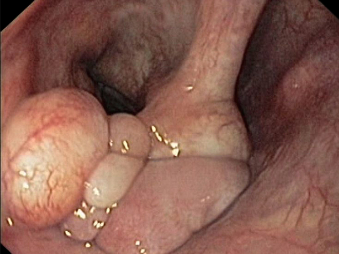 Persistent sore throat could indicate laryngeal cancer