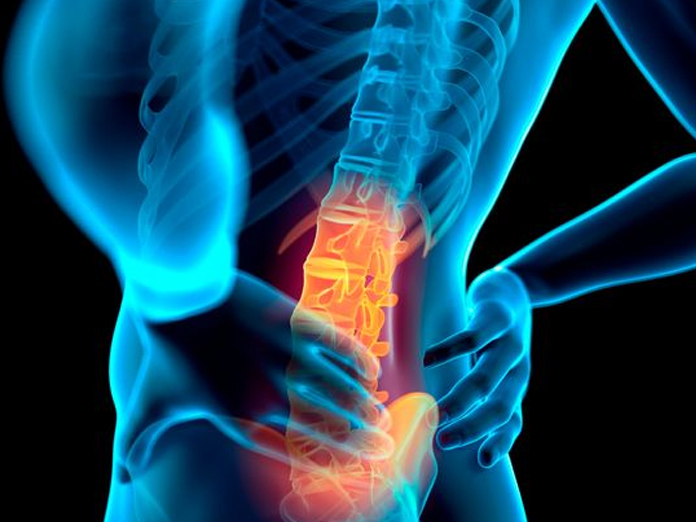 Researchers study patterns of back pain