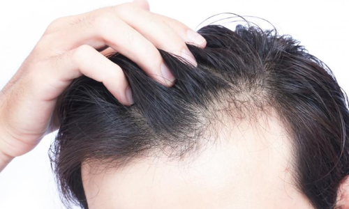 Vitamin D levels can now be measured with your hair