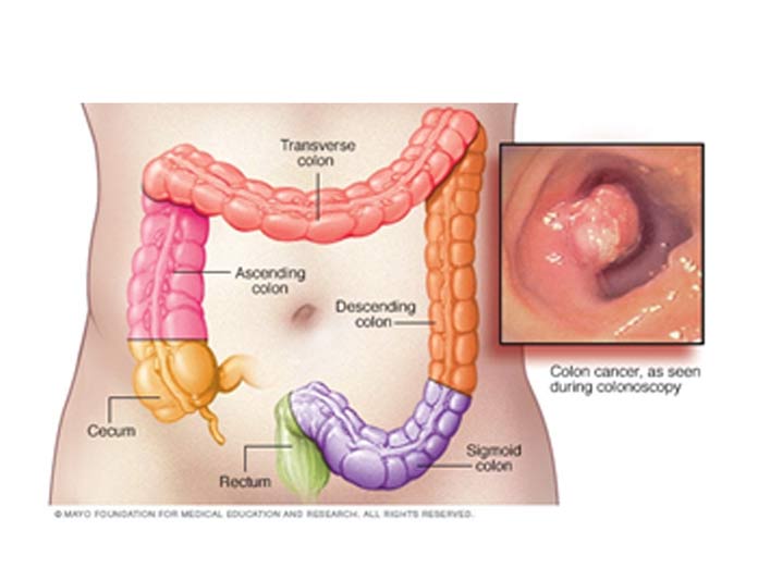 ALL ABOUT COLORECTAL CANCER