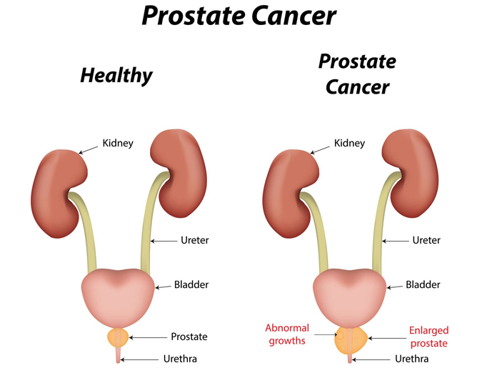 Shorter duration of radiation safe in treating prostate cancer: Study