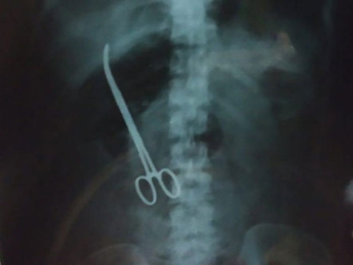 NIMS doctors leave scissors inside womans abdomen in Hyderabad