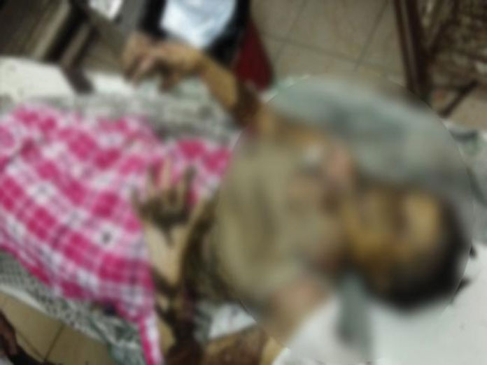 Girl set on fire by stalker for rejecting love in Warangal