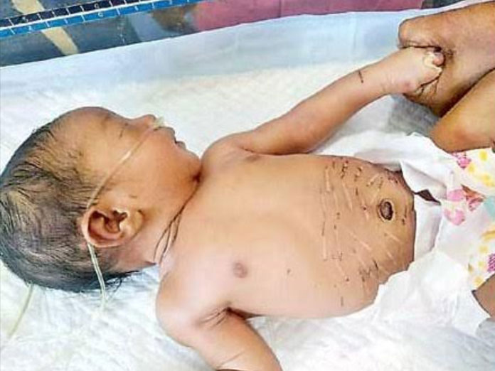 Newborn branded with hot iron in Vizianagaram