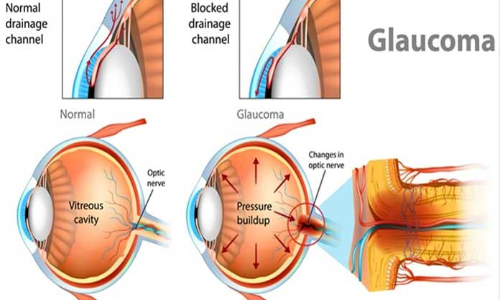 20% of adult population suffers from glaucoma