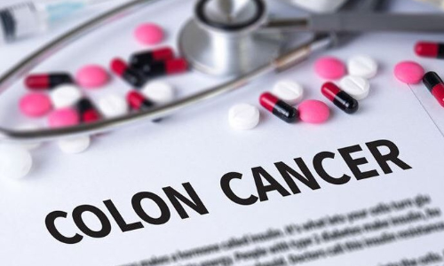 Colon cancer growth reduced by exercise: Study