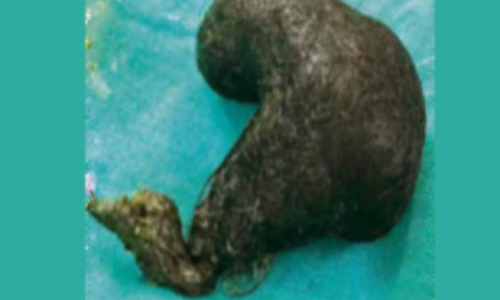 Hairball removed from 15-year-old girl\s abdomen in Medak