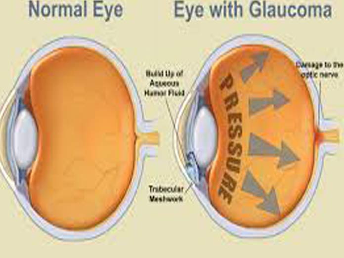 AMD leading cause of blindness in elderly