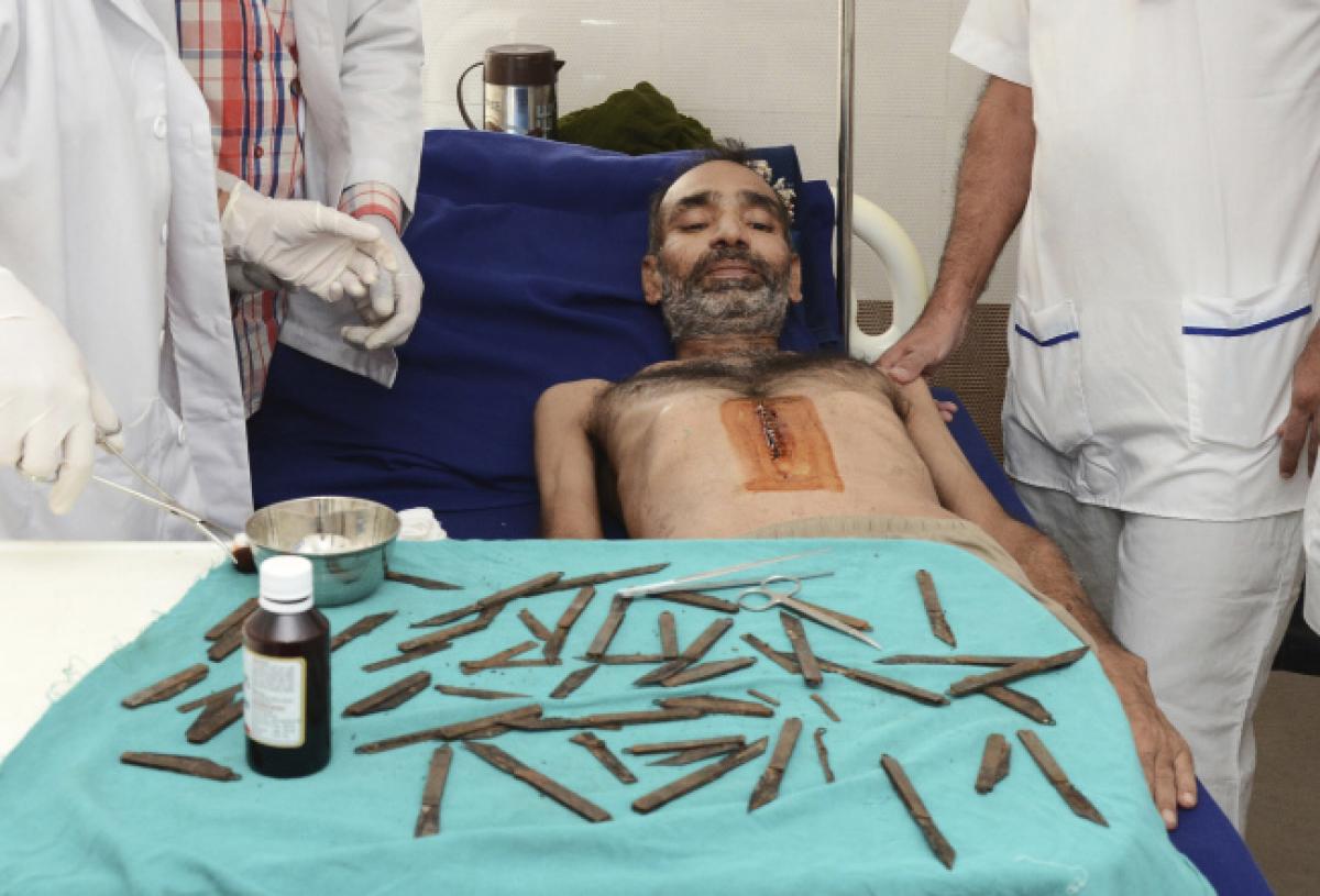 In a never before heard surgery, doctors remove 40 knives from mans stomach