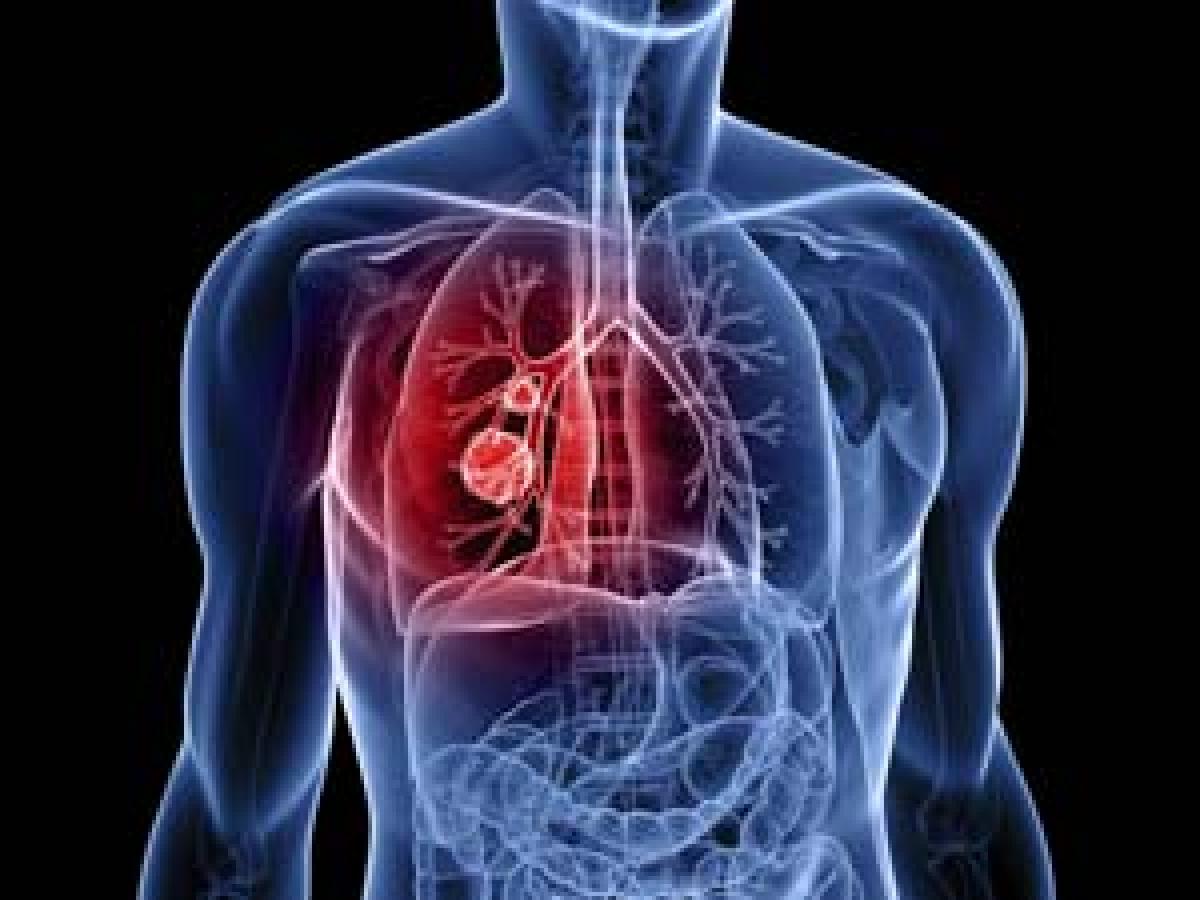 Upto 73% higher survival rate on early detection of lung cancer
