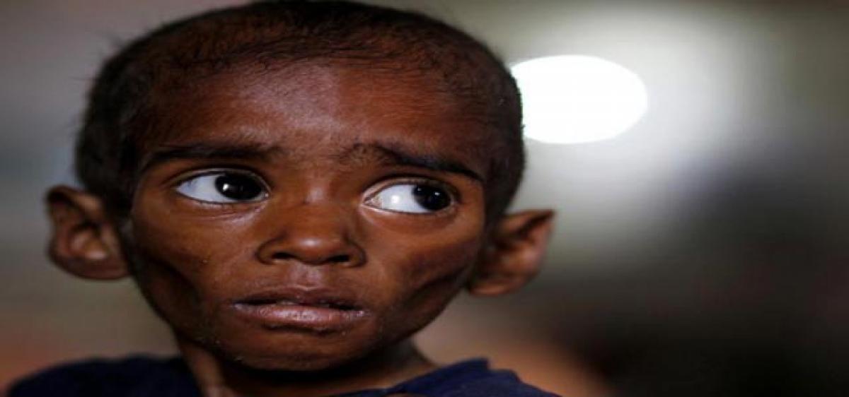 Mental disorders high among malnourished children 