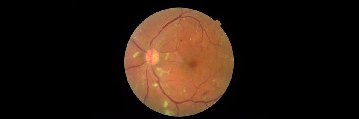 Googles new AI model to help detect diabetic retinopathy