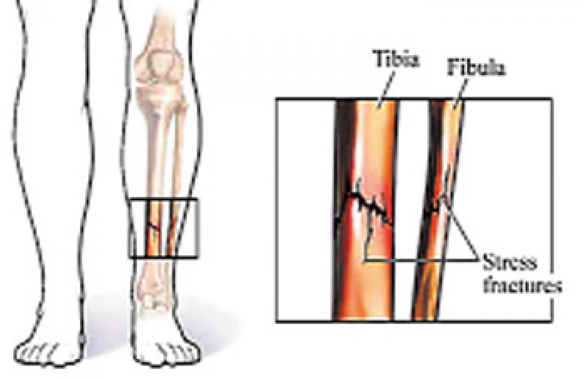 Genes influence stress fractures