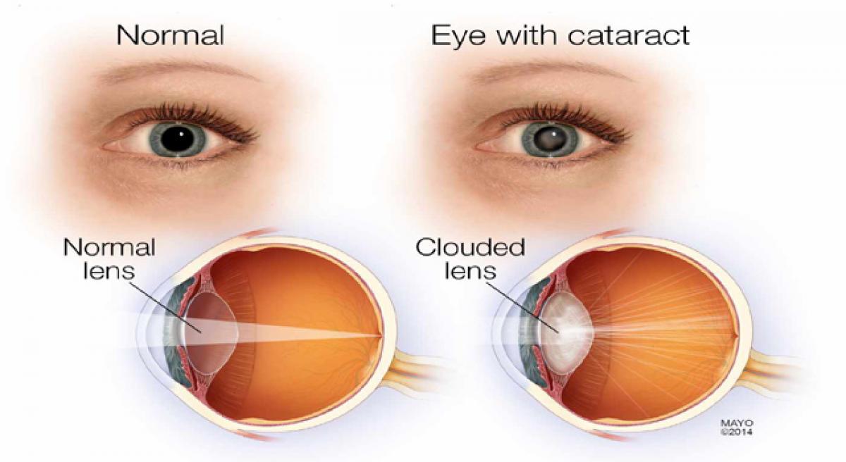 On lens care and cataract