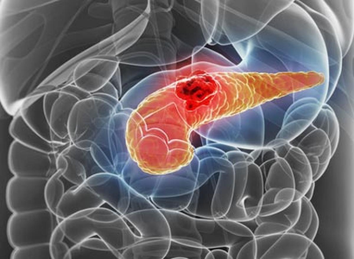 Overweight people can use diabetes drugs to slow pancreatic cancer growth