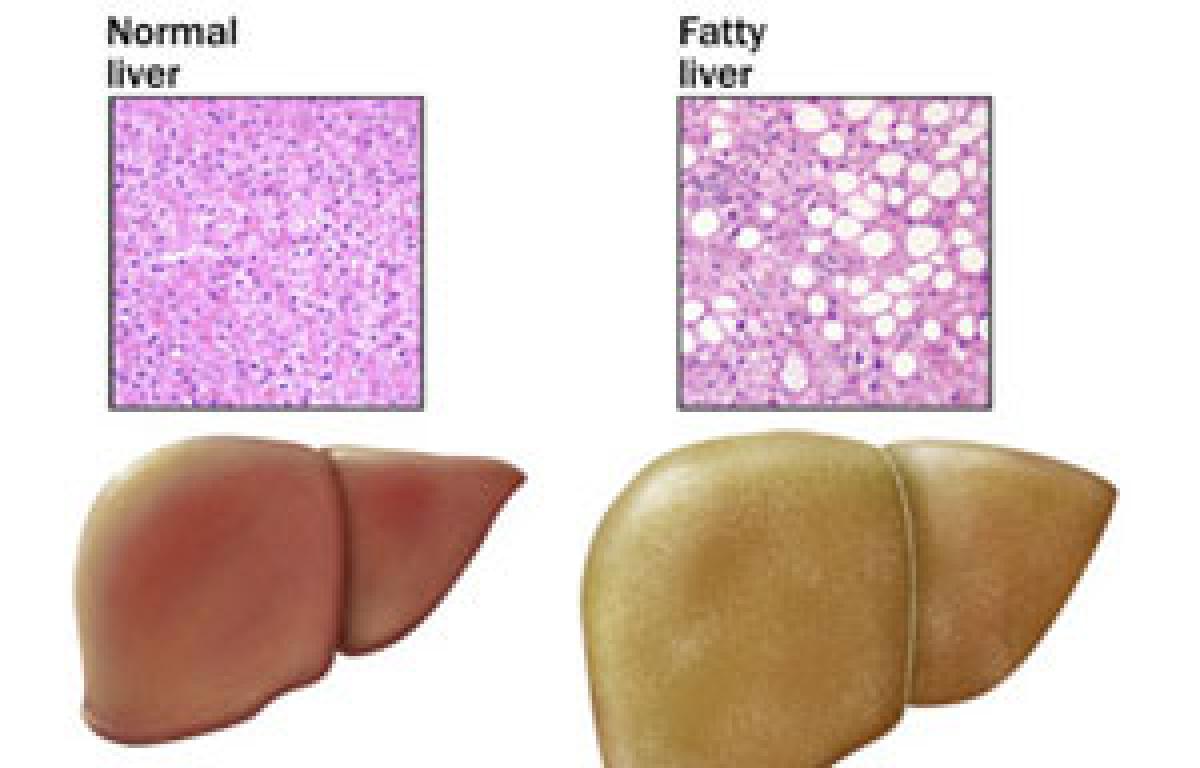 Nonalcoholic fatty liver disease an independent risk factor for atherosclerosis