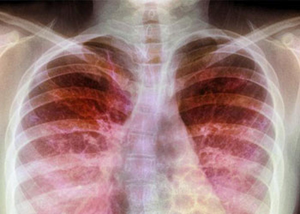 Indian origin scientists finds a way to spot cystic fibrosis