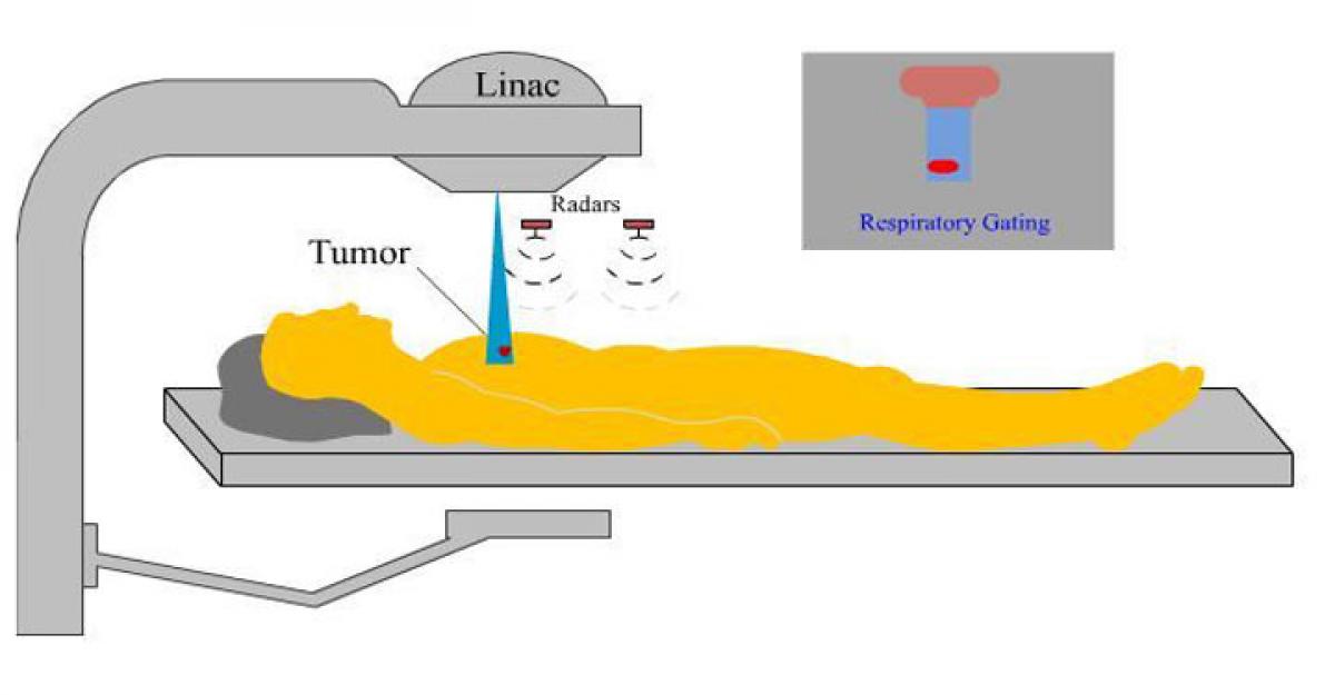 New radiation therapy better for lung cancer treatment