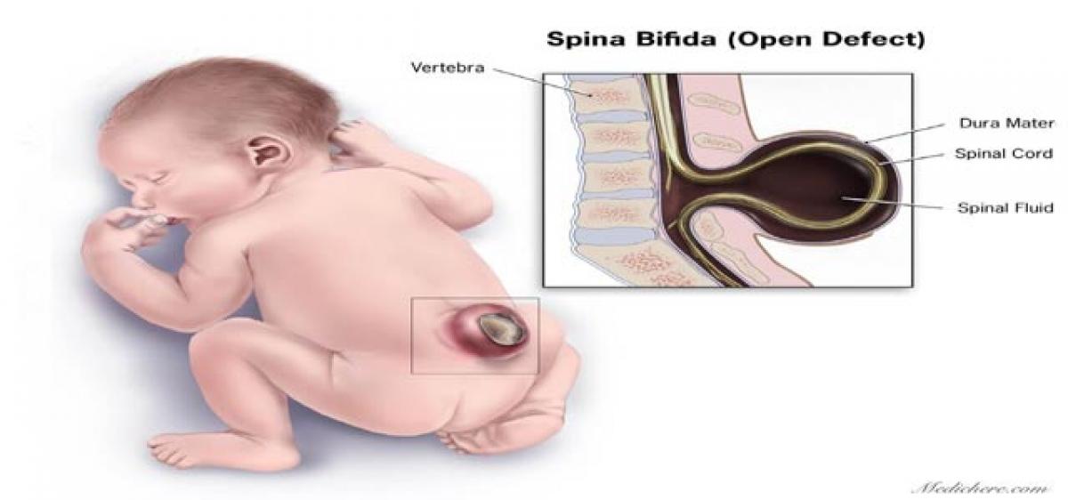 10% more chance of second child to have Spina bifida: Doctors