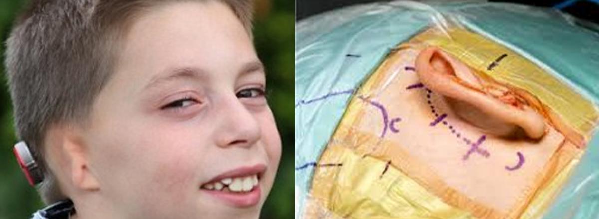 Earless boy gets one made from his own ribs