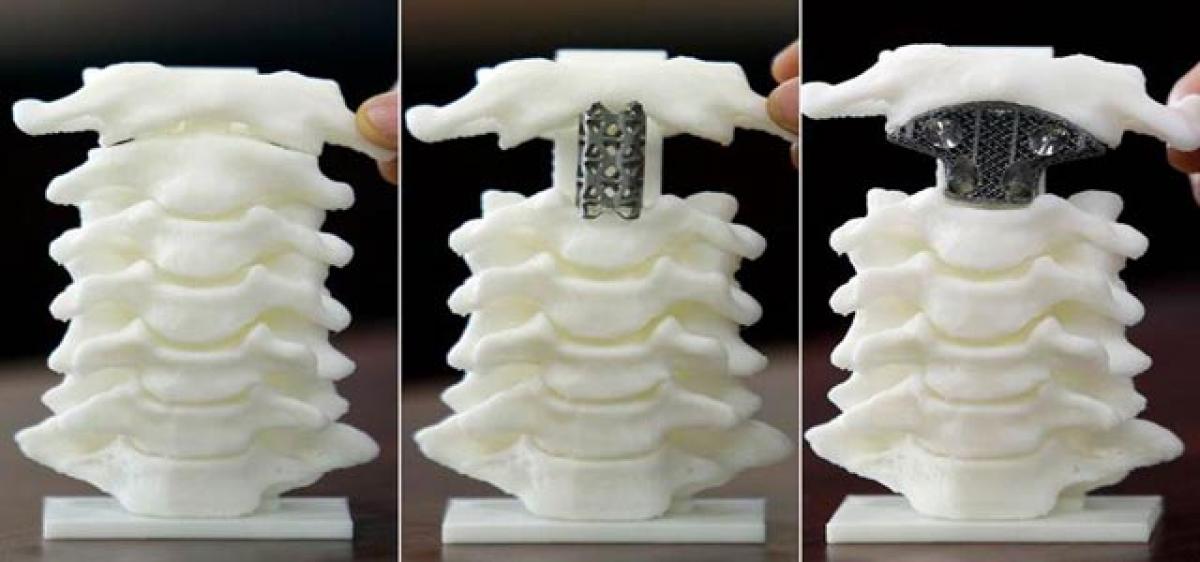 3-D-printed bone implant dissolves in the body