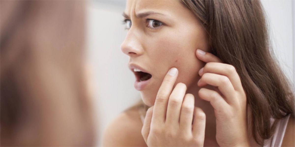 Simple tips to keep acne at bay