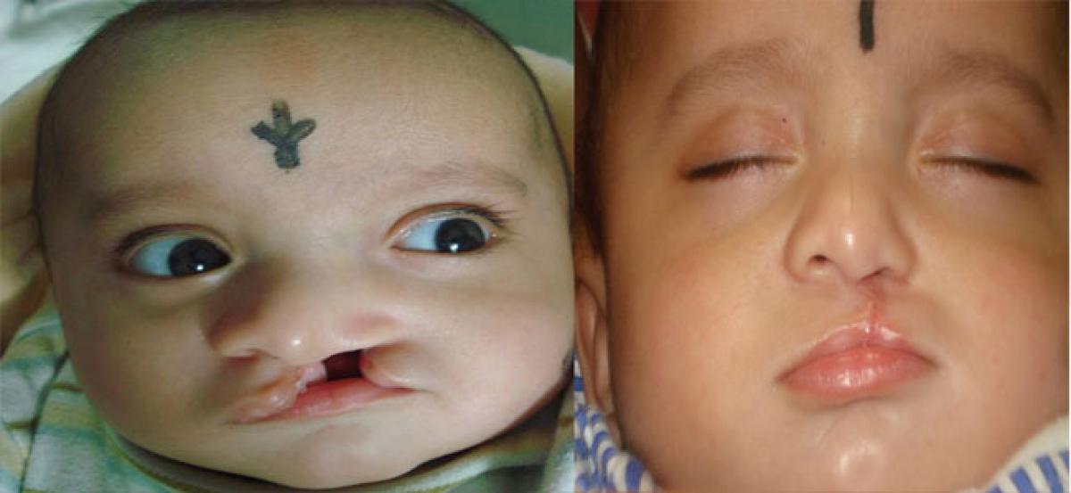 Free plastic surgery for cleft lips