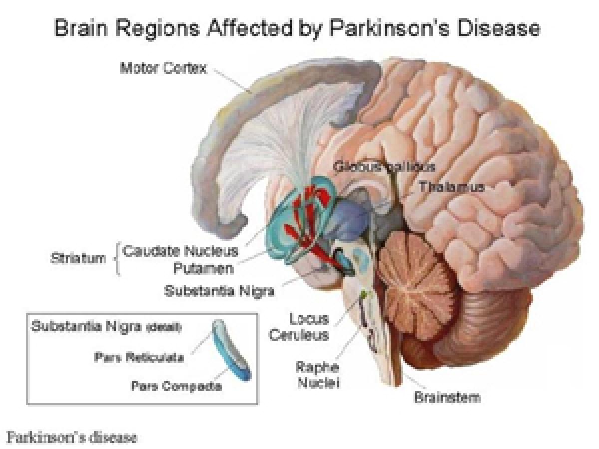 Parkinsons disease linked with many forms of cancers