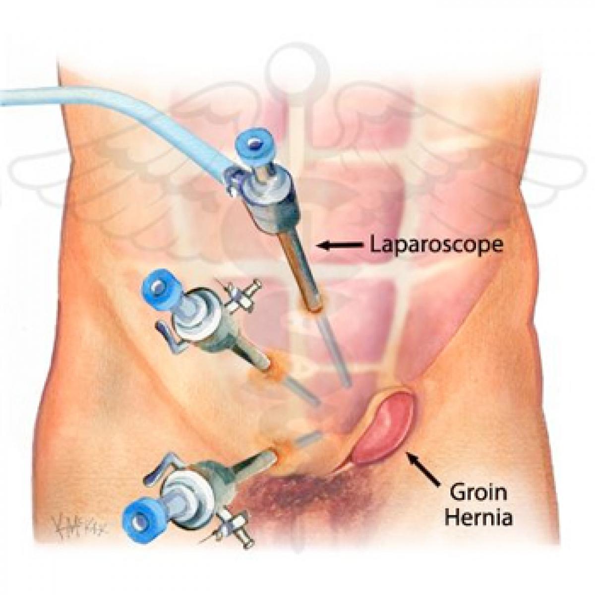 Hernia can be fixed by a small operation