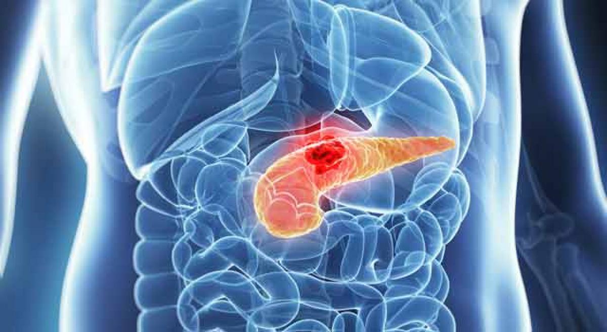 Oral bacteria may help spot pancreatic cancer