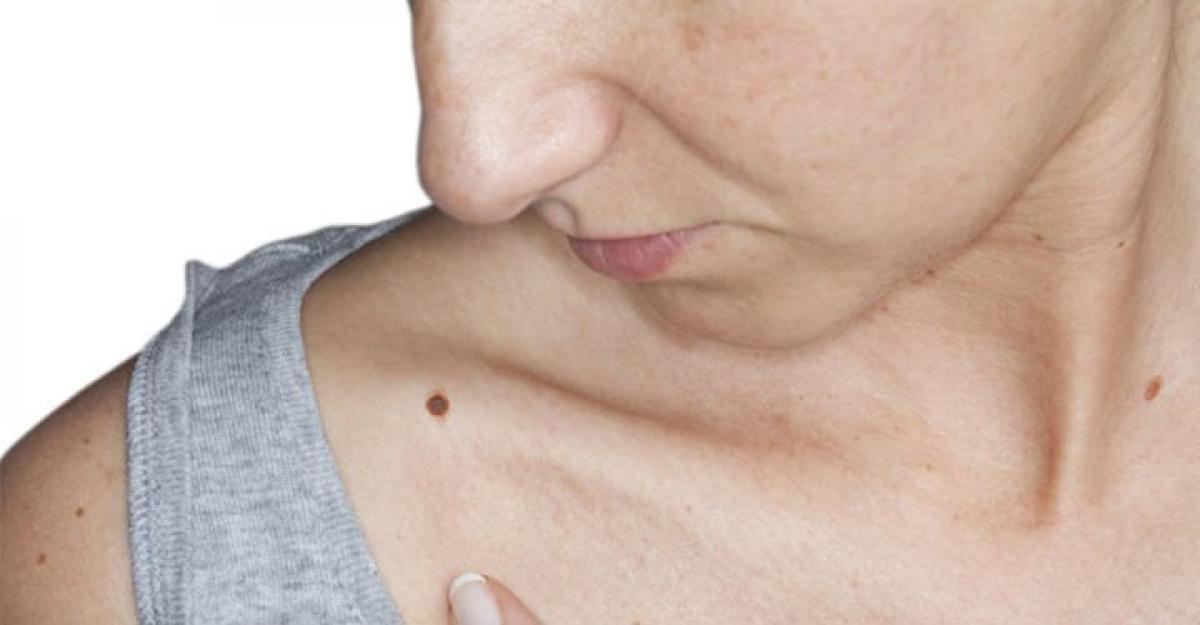 Moles On Arm Can Predict Deadly Skin Cancer Risk 