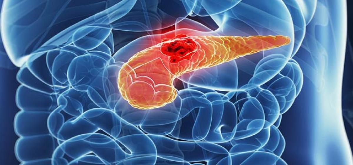 Diabetes may be warning sign for pancreatic cancer