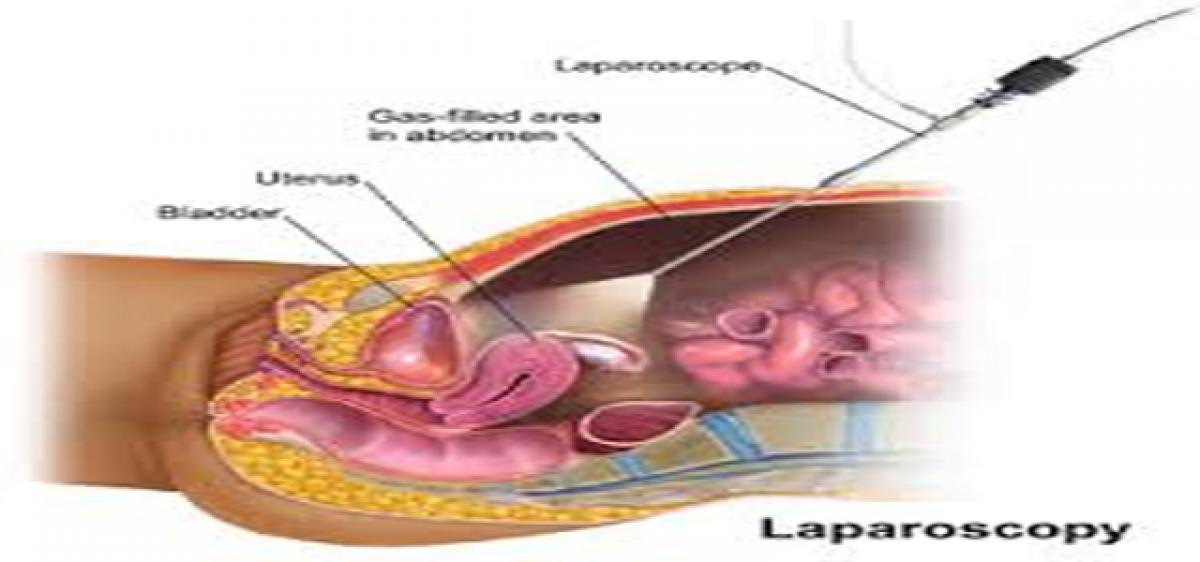 Rare laparoscopic surgery performed