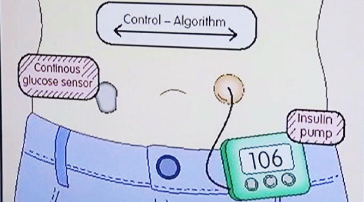 Artificial pancreas may soon be a reality