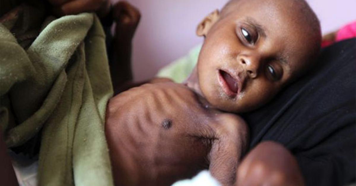 Malnutrition among children under five years of age