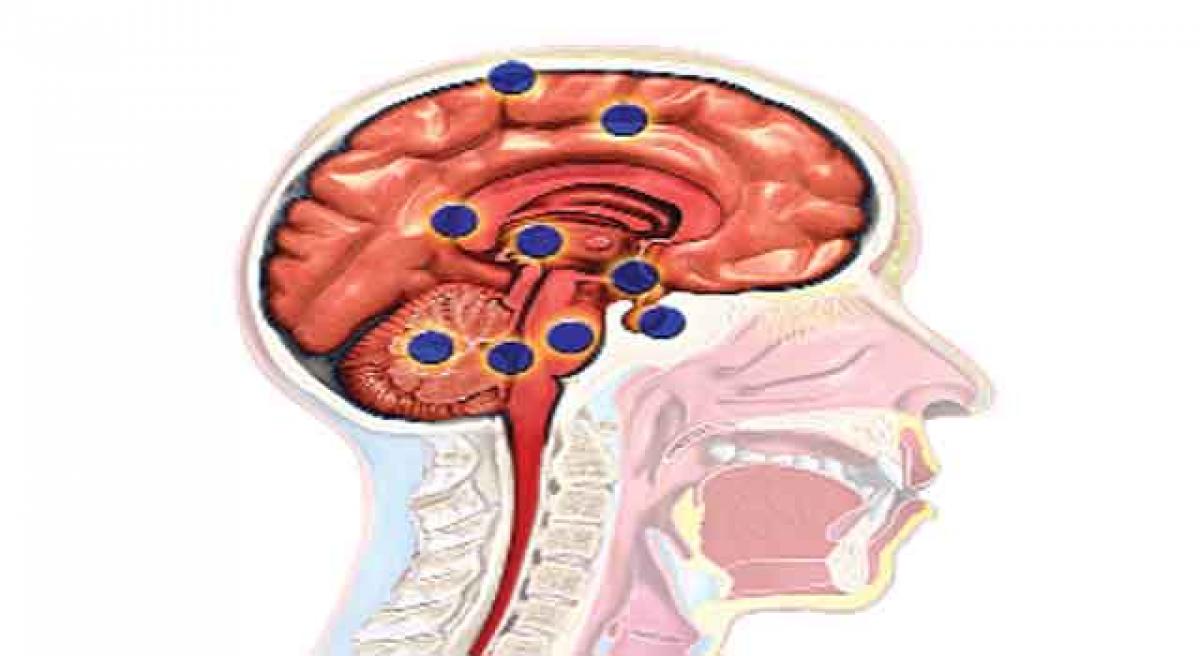 High blood sugar can lower risk of one type of brain tumour