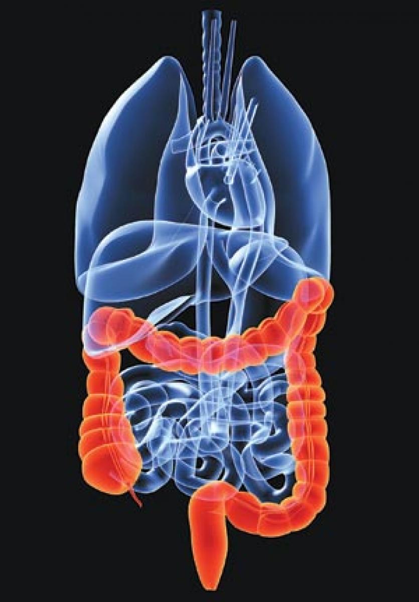 How inflammation in the gut ups risk of colon cancer