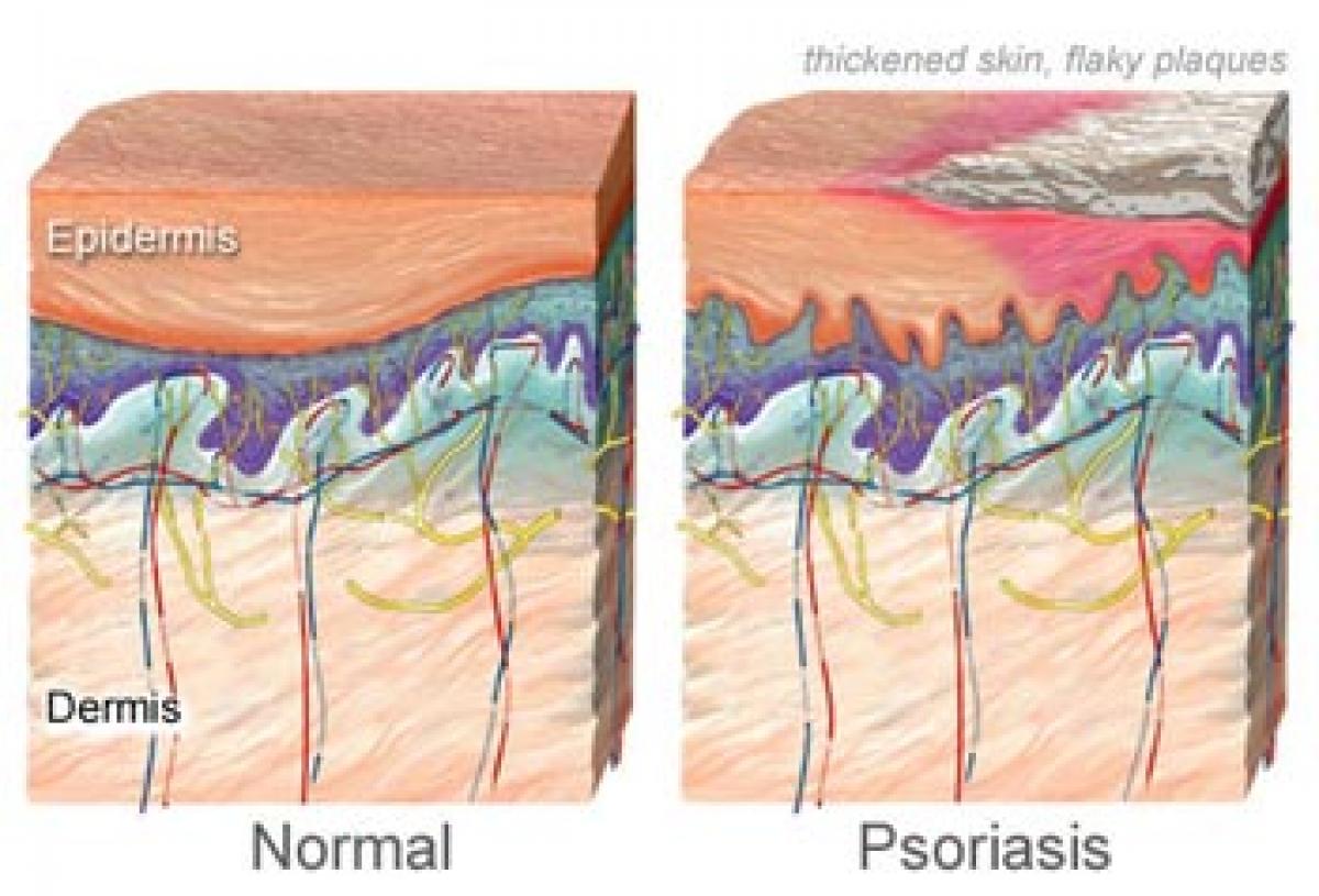 Stress can cause psoriasis