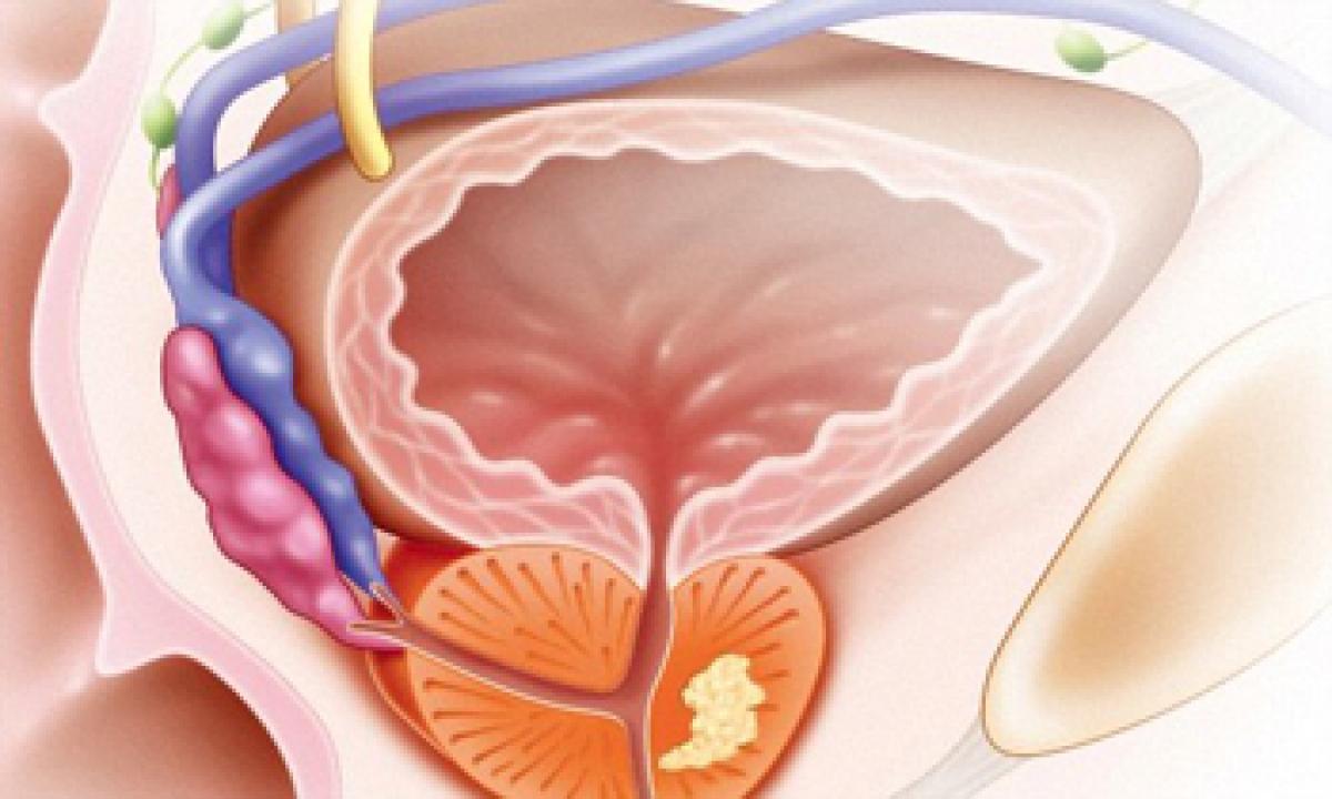 Device to smell prostate cancer